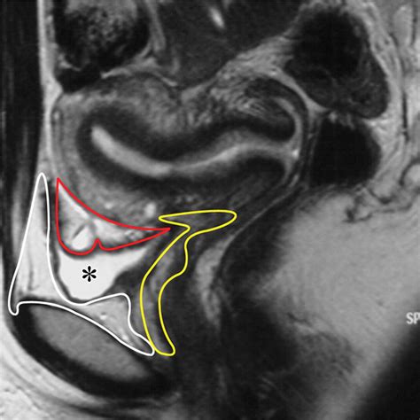 deep endometriosis mri